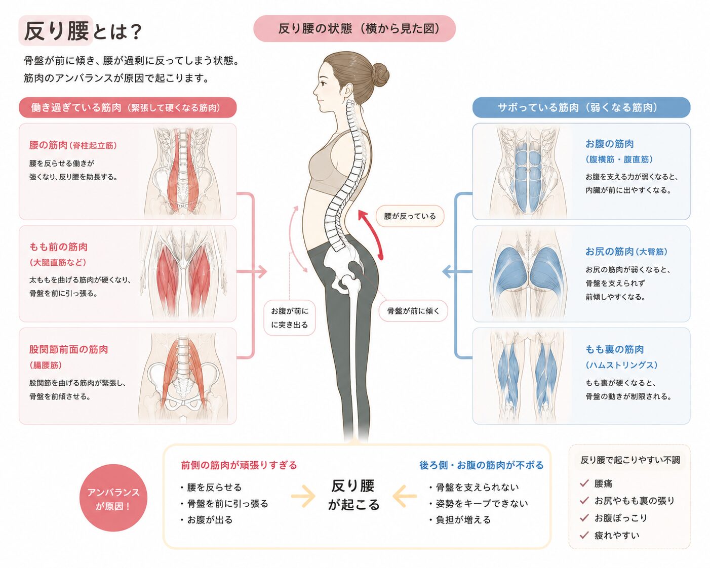 反り腰の状態を横から見た図。働きすぎる筋肉とサボっている筋肉のアンバランスの図解